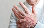 Arthritis (Rheumatoid Factor) Home Test Kit UK Arthritis (Rheumatoid Factor) Home Test Kit UK